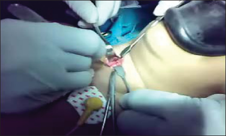 Procedure of tracheostomy.